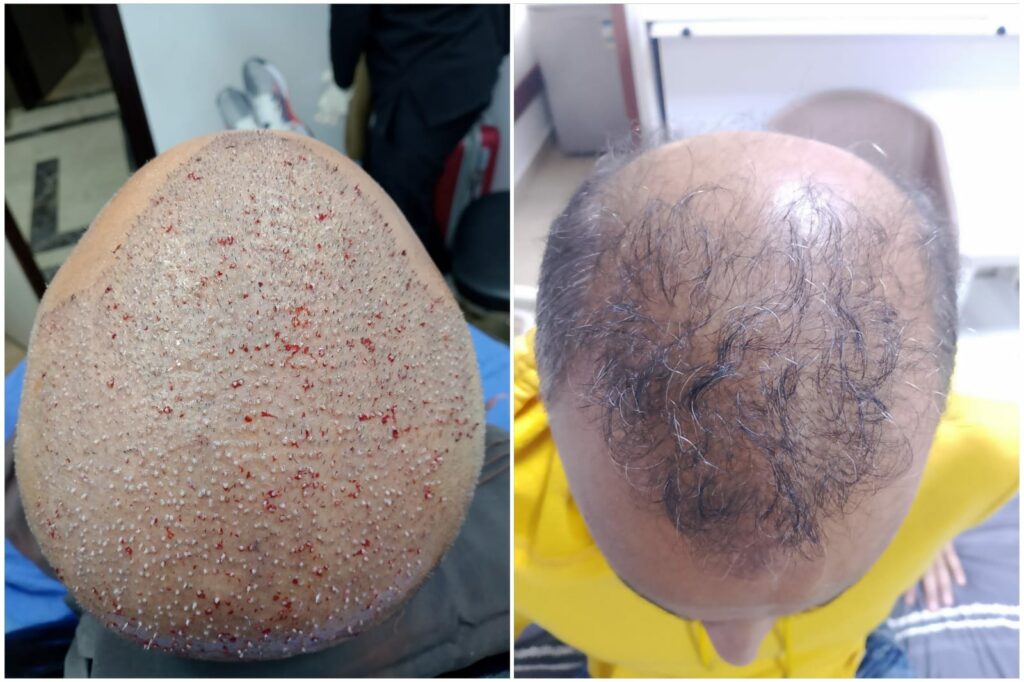 تكثيف منطقة تاج الرأس بتقنية قلم السفير